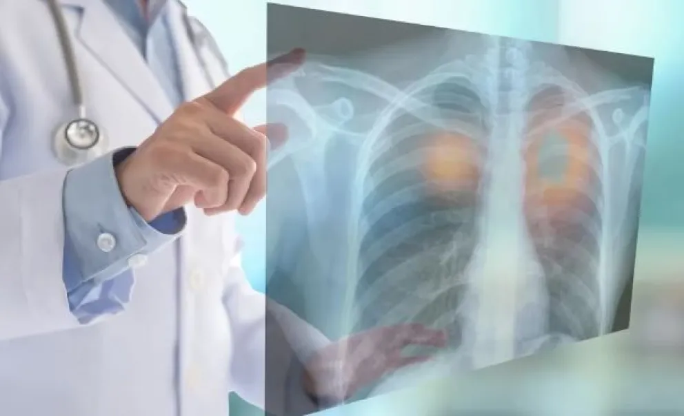 Cáncer de pulmón: la importancia del diagnóstico precoz ante uno de los tumores más frecuentes