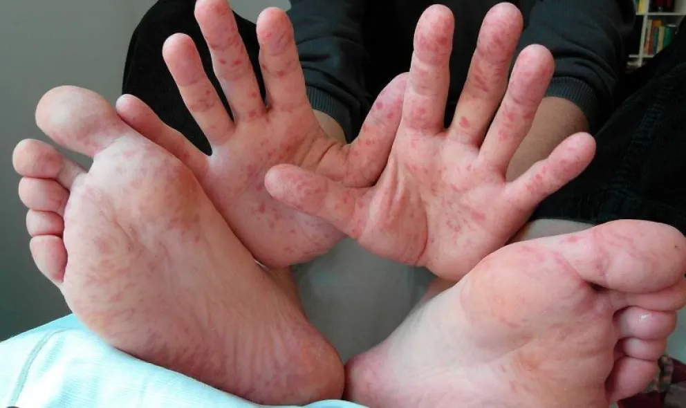 Casos del virus mano-pie-boca: “No hay que automedicar a los niños y deben acudir al pediatra” 