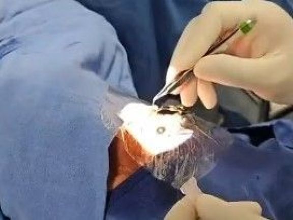Realizaron en Estados Unidos el primer trasplante de ojo completo del mundo