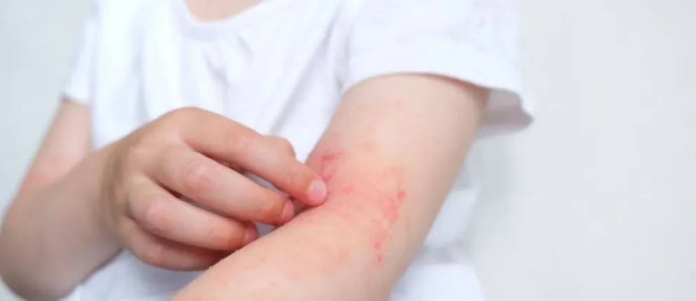 Estiman que hay 75.000 misioneros con dermatitis