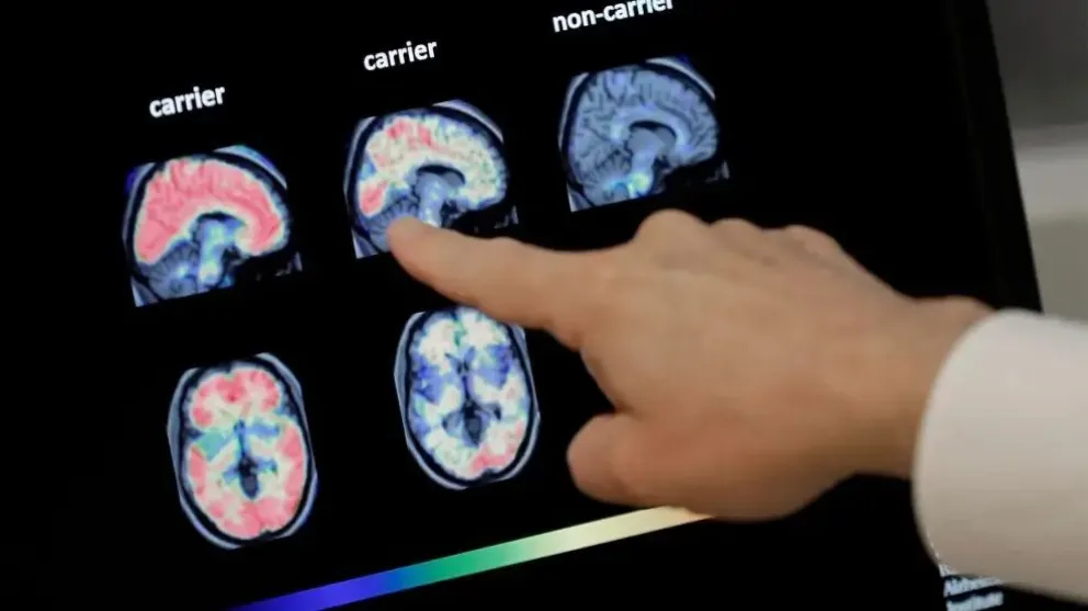 Una investigación descubrió cinco casos de Alzheimer transmitidos entre personas mediante la hormona de crecimiento