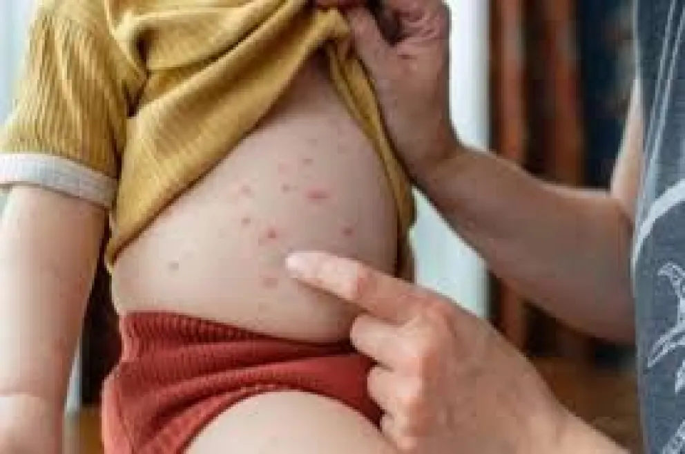 La población pediátrica no vacunada es la más susceptible a contraer la enfermedad.