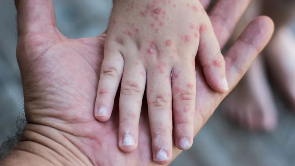 El sarampión es una enfermedad viral altamente contagiosa. //Foto: Freepik.
