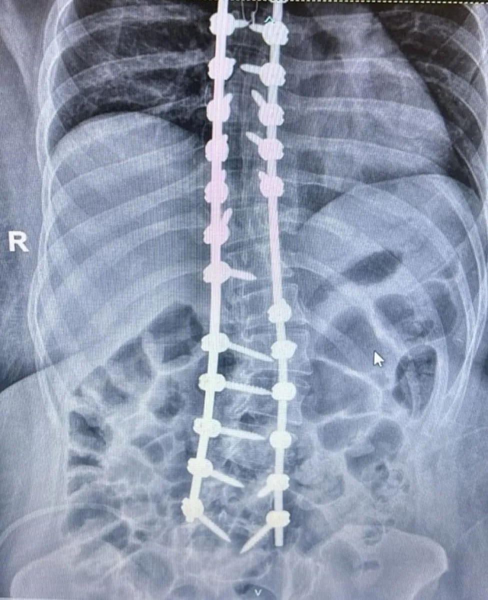 Se hizo en el Madariaga la primera cirugía de escoliosis con innovadora técnica imagen-8