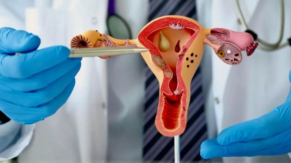 Día Mundial de la Endometriosis: entre el 50% y el 70% de las mujeres pueden lograr un embarazo espontáneo imagen-6